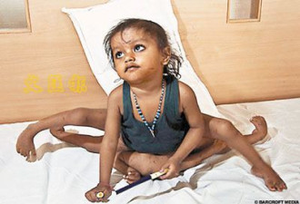 印度多肢女童手术去掉多余四肢后出院