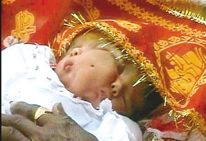 印度辛格夫妇生下两嘴四眼“双面女婴”