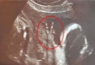 未出生婴儿在妈妈肚里比出V字胜利手势