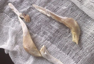 80后MM整容：削骨手术后 网上晒骨头