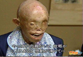 老照片:惨遭原子弹轰炸后的日本市民
