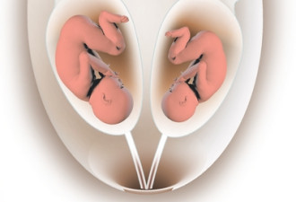 孕妇双子宫均怀孕诞下龙凤胎 医学奇迹