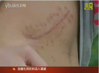 17岁高中生2万元卖掉自己右肾买iPad(图)