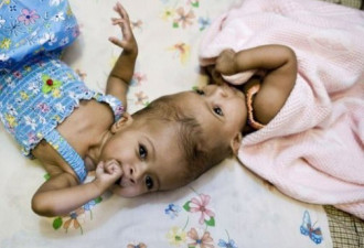苏丹头颅连体双胞胎女婴在英手术分离