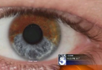 美国医生发明眼球变色术 20秒褐眼变蓝