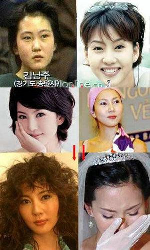 韩国首批整容者遭遇后遗症 美女变加菲猫(组图)