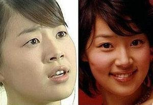 韩国首批整容者遭遇后遗症 美女变加菲猫(组图)