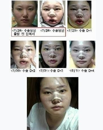 慎入！韩国女人整容全纪录：图解痛苦的蜕变过程(组图)