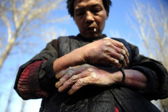 惨无人道:智障劳工在北京黑豆腐作坊内被虐致死(高清组图)