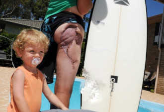 澳男子冲浪 被鲨鱼咬掉大腿根3.6斤肉