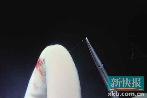 女子自称成为了整形试验品:全身被埋线 痛不欲生(组图)