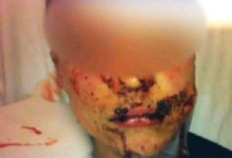 加国12岁女童偷饮料 遭警犬咬烂脸部