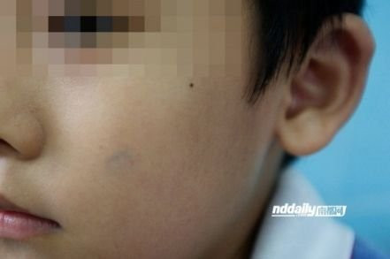 深圳:小学生表现不好 脸上被盖蓝色印章(组图)