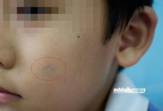 深圳:小学生表现不好脸上被盖蓝色印章