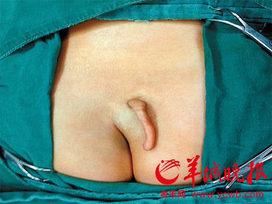 广东一女婴天生屁股上长着小尾巴 专家称或诱发疾病(图)