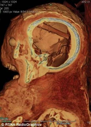 科学家从2400年前木乃伊头骨内发现移除大脑工具(组图)
