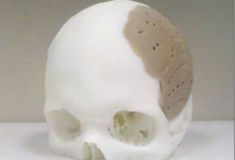 首创3D打印头骨技术 病人换75%头骨