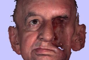 英国半脸男子借助3D打印术 重做新脸
