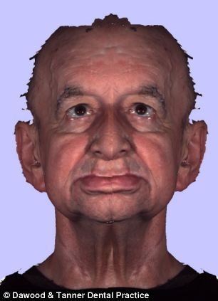 英国半脸男子借3D打印术重做"新脸" 不久将结婚(慎入/组图)