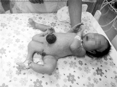 河南：男婴长四条腿两生殖器 未满月遭父母遗弃(图)