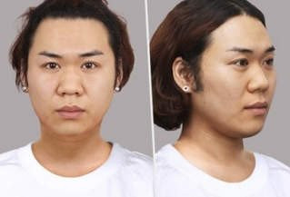 韩“女版史瑞克”砸200万整容大变身