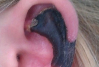 22岁女子遭蜘蛛咬伤 耳朵竟被毒液溶解