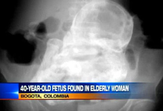 哥伦比亚8旬老太腹内发现40年前死婴