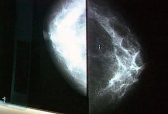 乳房拍片年检 不能降低乳腺癌死亡率