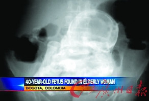 巴西八旬妇肚中发现存留40年“石婴”