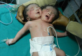 罕见! 印度一名女子剖腹产下双头女婴