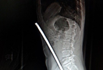 最诡异的X光照片：钢筋透体大难不死