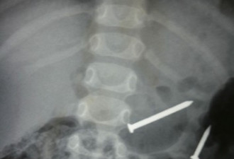 最诡异的X光照片：钢筋透体大难不死