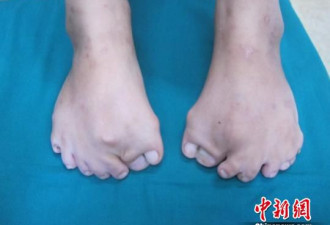 重庆八岁女孩患怪病 双脚长15根脚趾
