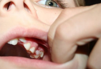 印女童嘴莫名肿痛 医生取出202颗牙齿