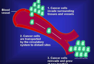 日本研究发现遏制癌细胞转移的药物