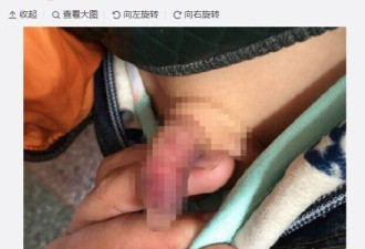 幼儿园老师打断娃娃命根 园方: 不知情