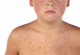 加国新增麻疹病例引关注 孩童须注意