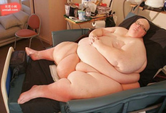 慎入！445公斤世界最胖男子瘦下来了