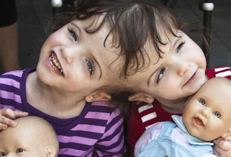 加连体婴姐妹7岁 能用对方眼睛看世界