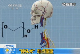 中国医生主刀首例换头术 引巨大争议