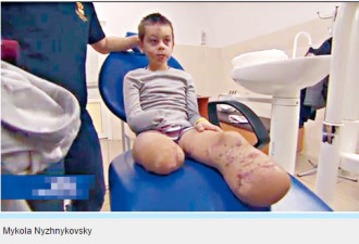 乌克兰男孩被炸掉四肢 加拿大免费治疗