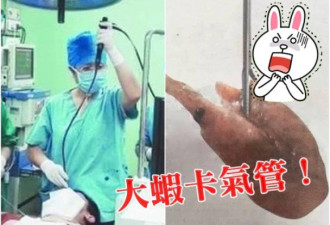 山东汉咳血求诊 医生气管“钓”出大虾