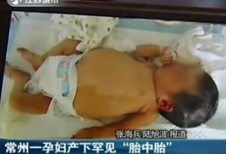 出生9天的女婴被发现肚里还怀着一个胎儿