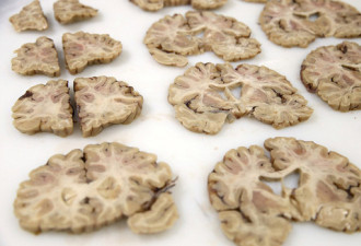 揭秘英国最大大脑银行 上千大脑样本被切片保存