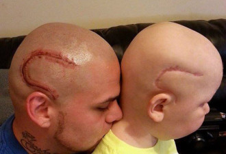 男孩脑瘤治愈后留下疤痕 父亲纹了个一样的