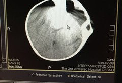 男婴从床上摔下：头颅被蚊香金属架插入3厘米