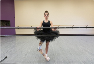 骨癌少女截肢用脚踝代替膝盖 重回芭蕾舞台