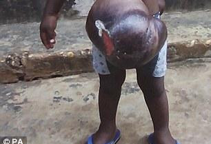 加纳3岁男孩脏器长在体外 即将进行救命手术