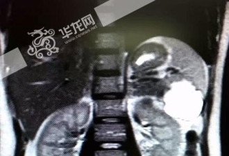 慎入：女子怀孕却找不到宝宝 胎儿竟长在脾脏上