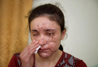 IS囚禁3000名性奴 18岁少女逃出被地雷炸瞎